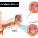 Four Advantages of Ear Tubes for Children