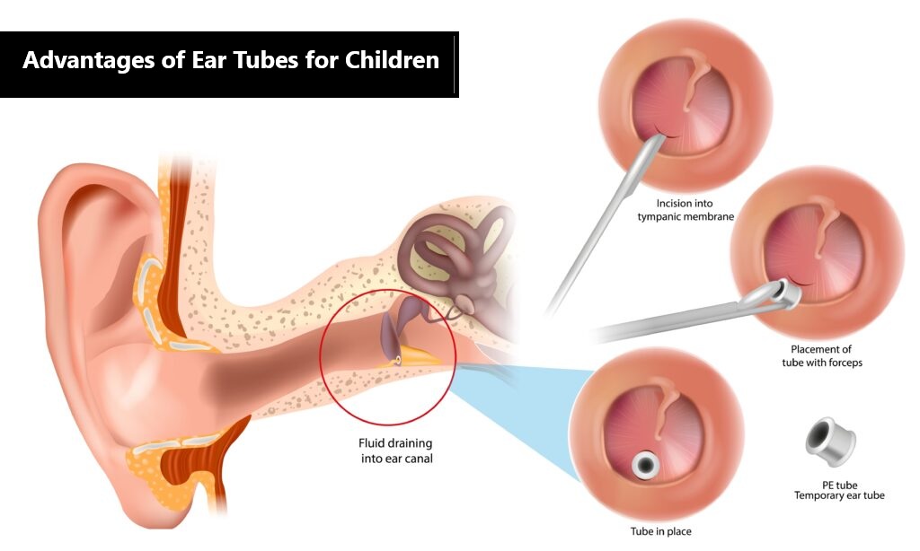Four Advantages of Ear Tubes for Children