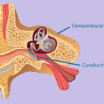 The different types of Hearing Loss