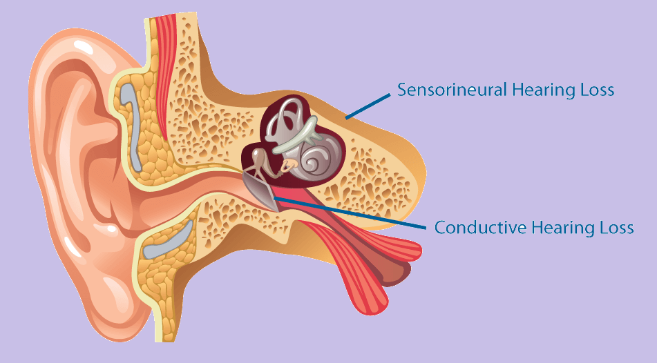 The different types of Hearing Loss