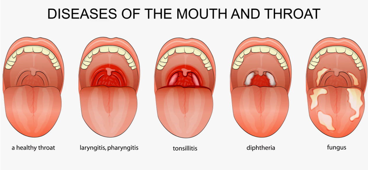 Frequent Throat Infections or Hoarseness