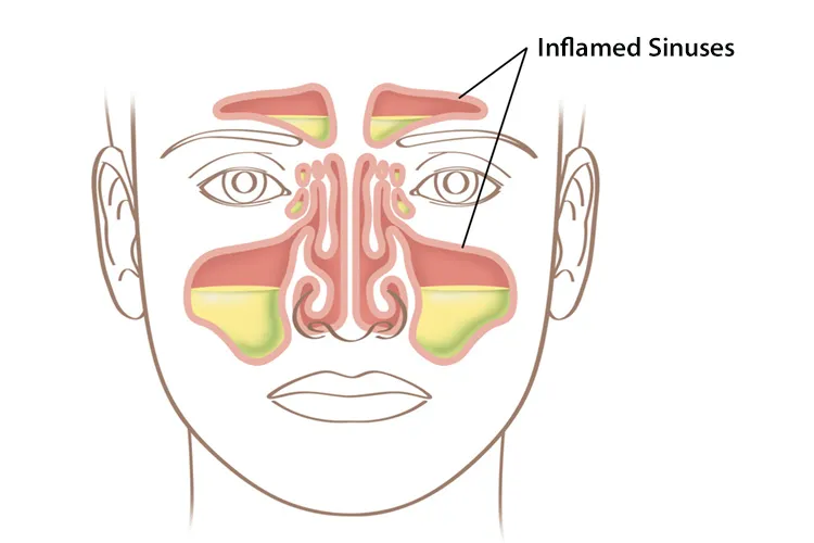 Nasal Blockage That Doesn’t Go Away