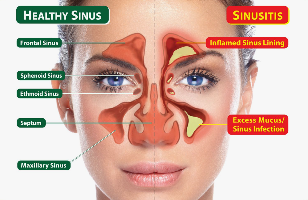 Chronic Sinus Headaches or Facial Pain